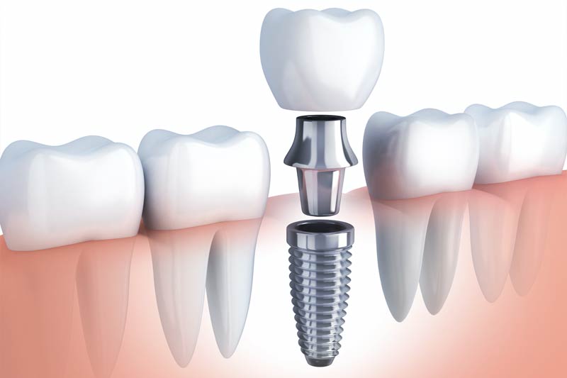 Implants Dentist in Valencia