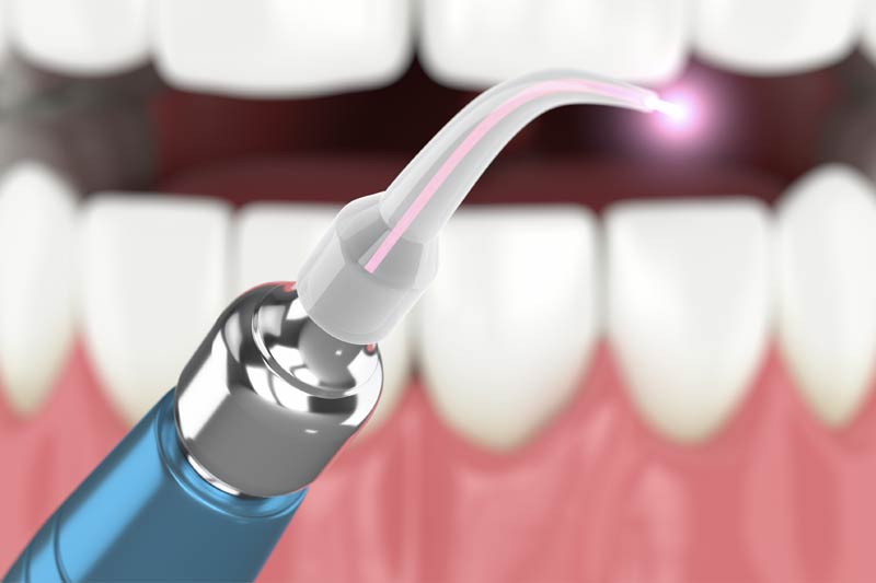 Laser Dentistry in Valencia