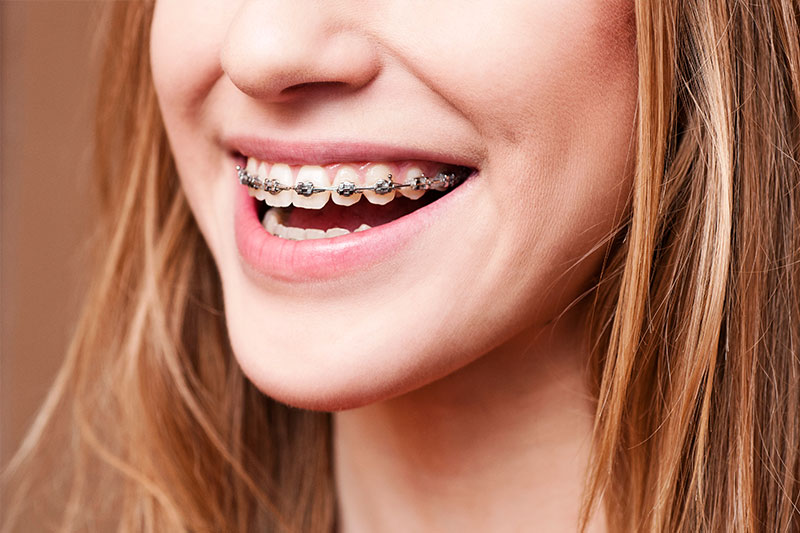 Orthodontics in Valencia