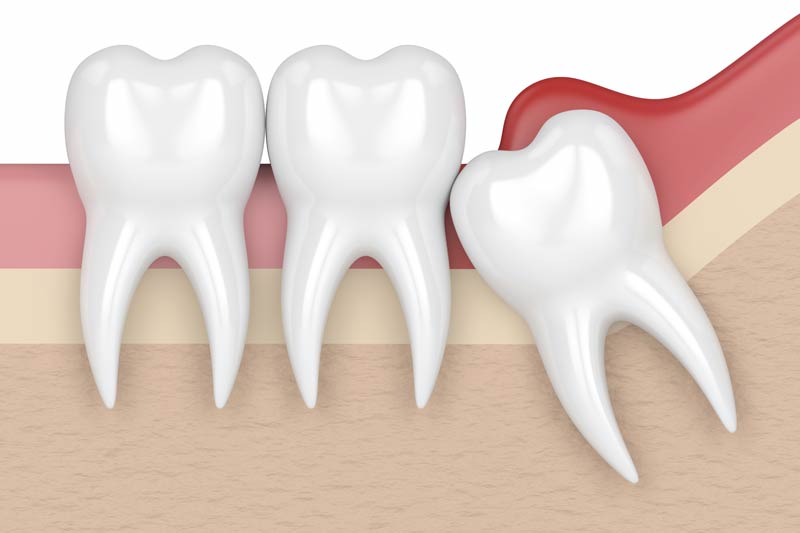 Wisdom Tooth Removal in Valencia